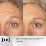 Before and after comparison of a person's face with wrinkles, showing a 100% improvement in appearance of wrinkles in 14 days.