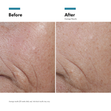 Before and after comparison of skin texture around the corner of the mouth, showing visible wrinkles and hyperpigmentation in the 'Before' panel and smoother, more even skin in the 'After' panel.