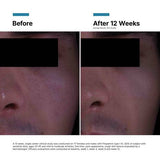 Before and after comparison of skin texture on a person's face, showing improvement over 12 weeks.