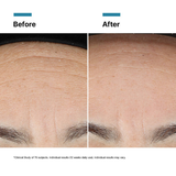 Before and after Advanced RGN-6 comparison of skin texture on a forehead.