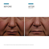 Phloretin CF Before and after